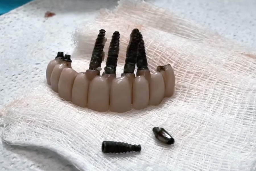 What to Do If Your Dental Implant Is Failing: A Doctor’s Guide to Handling Implant Rejection
