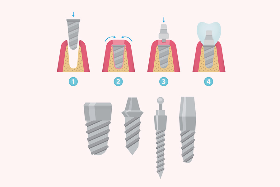 Types of Dental Implants: Which One Is Right for You?