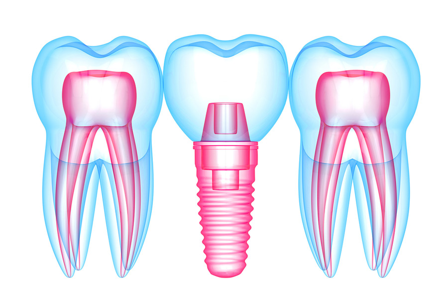 How 3D Technology Is Making Implant Treatment Faster, Safer, and More Precise